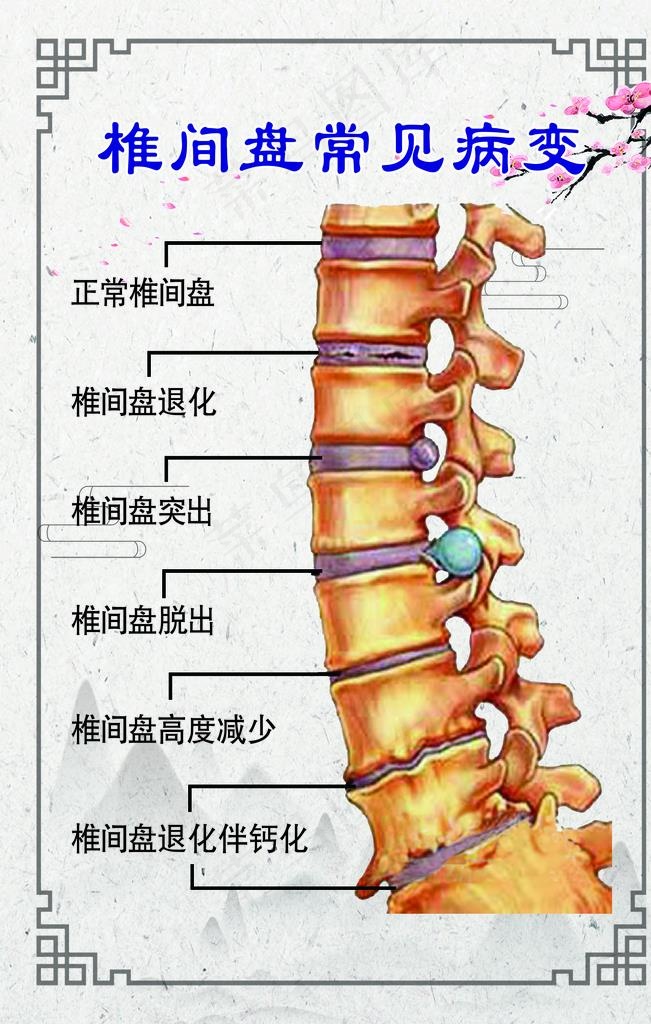 椎间盘常见病变图片(3543X5313(DPI:150))psd模版下载