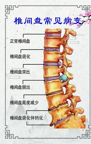 椎间盘常见病变图片