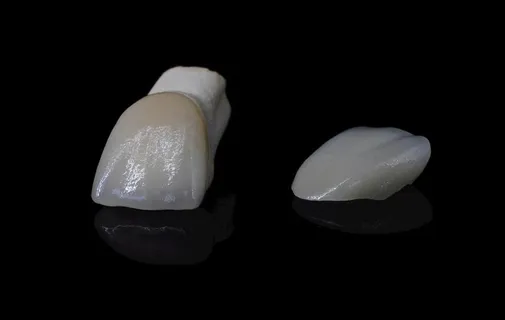 贴面 义齿 美学贴面 超薄贴面图片 贴面 义齿 美学贴面 超薄贴面图片