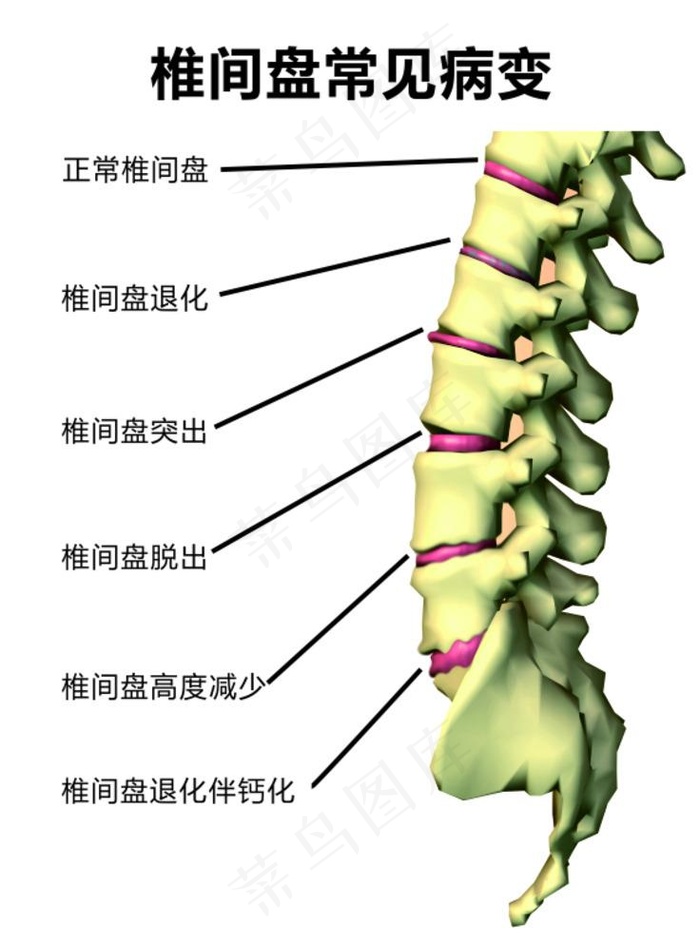 腰椎间盘常见病变图片cdr矢量模版下载