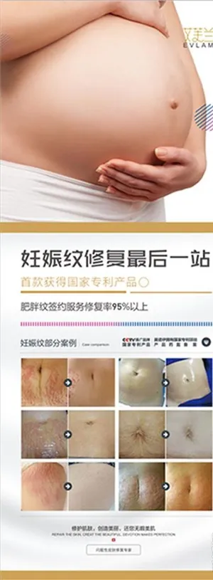 妊娠纹展架图片