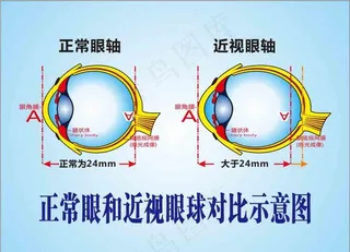 正常眼和近视眼球对比示意图图片