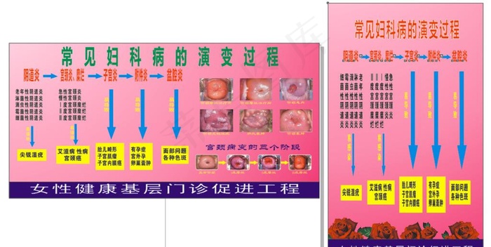 妇科病病变过程`图片(900X1500)cdr矢量模版下载
