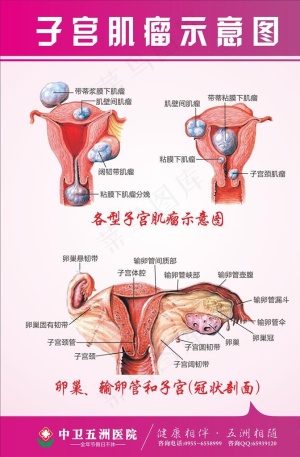 子宫肌瘤图片