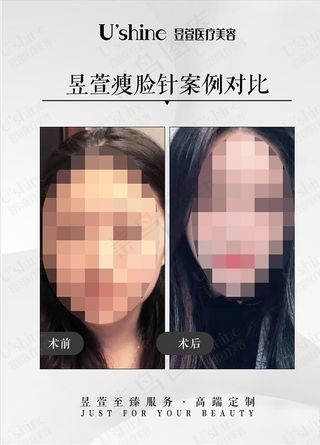 医美整形医院案例对比海报图片