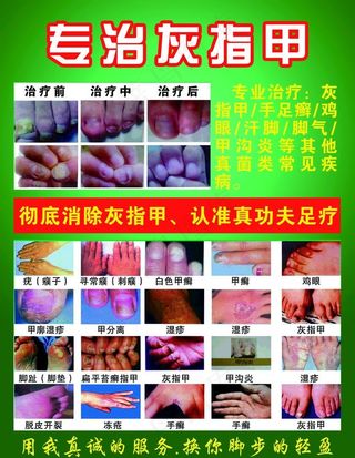 专治灰指甲图片
