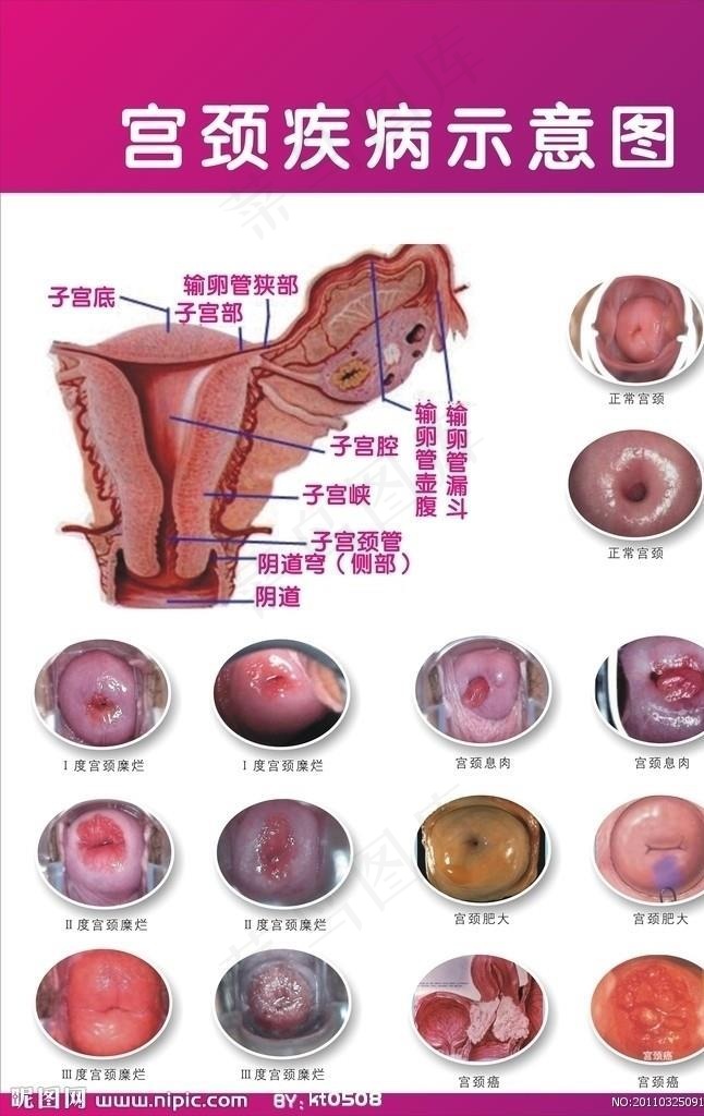 宫颈糜烂图片cdr矢量模版下载
