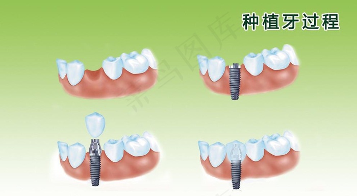 种植牙过程图图片