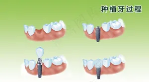 种植牙过程图图片