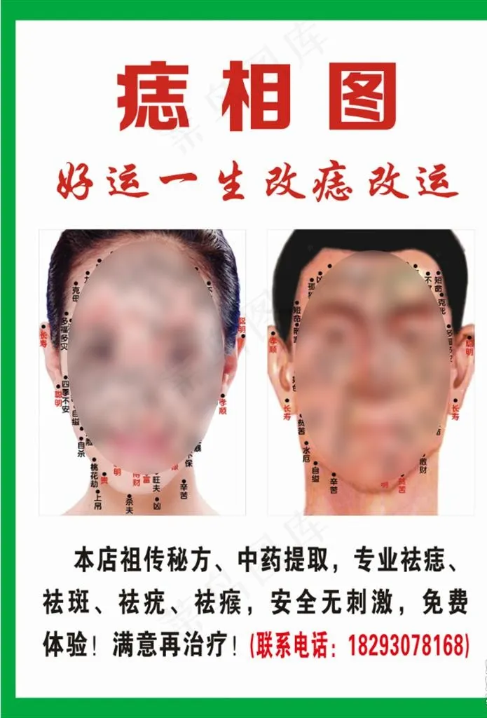 祛痣图图片