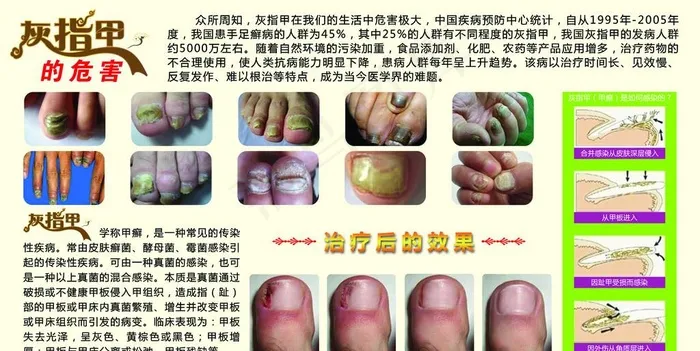 灰指甲的危害图片