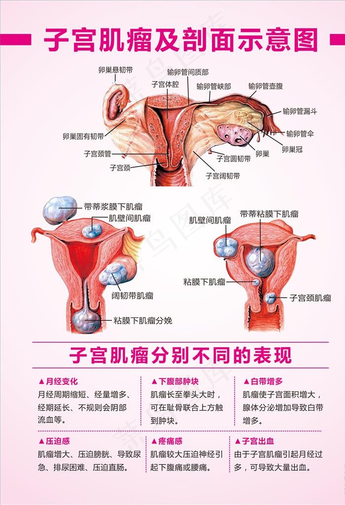 子宫肌瘤示意图 子宫肌瘤表现图片(500X700)cdr矢量模版下载