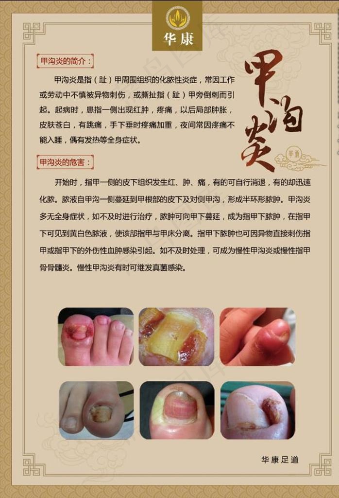 足疗 甲沟炎图片(3937X5512(DPI:200))psd模版下载