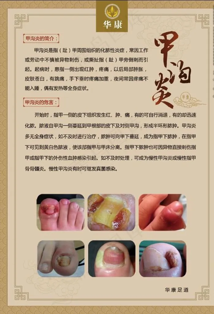 足疗 甲沟炎图片(3937X5512(DPI:200))psd模版下载