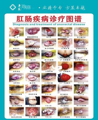 肛肠疾病图谱图片