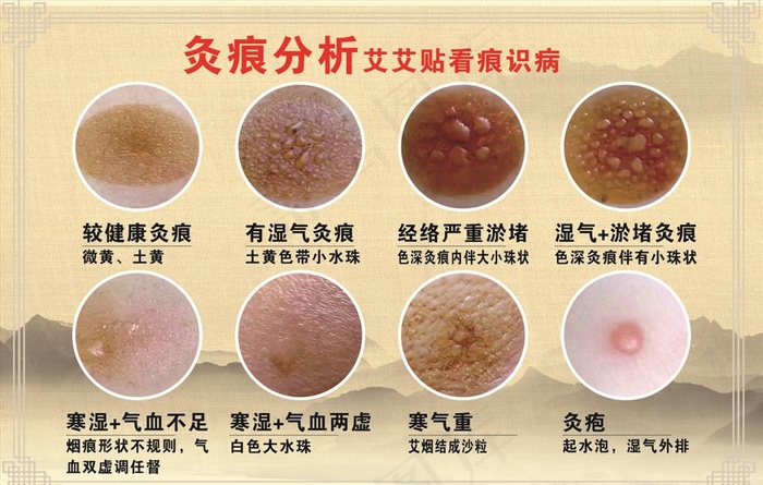 灸痕分析图片cdr矢量模版下载