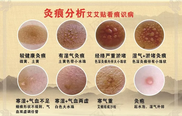 灸痕分析图片cdr矢量模版下载