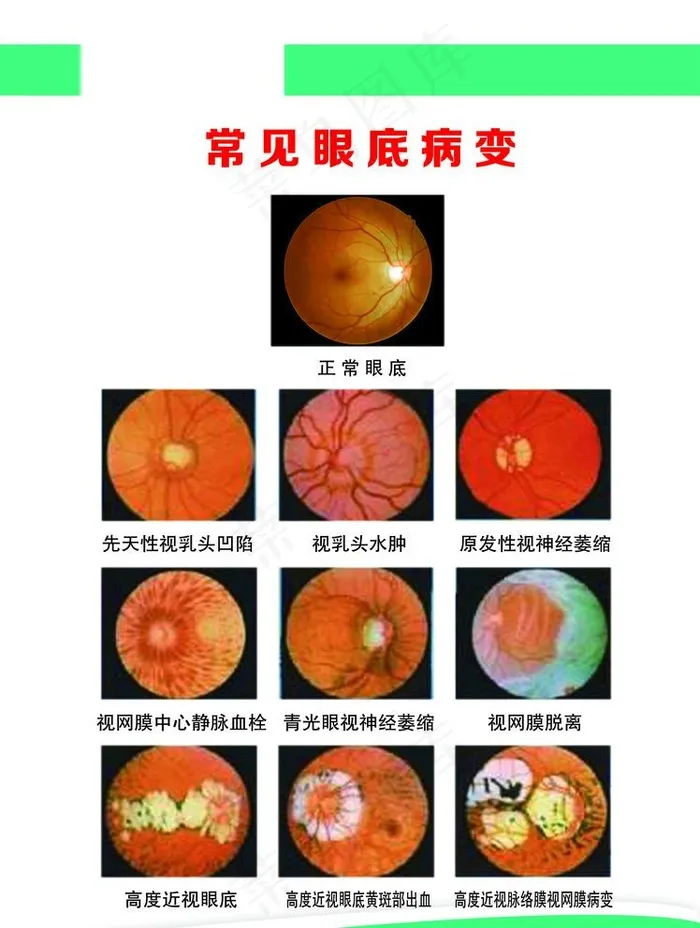 常见眼底病变图片psd模版下载
