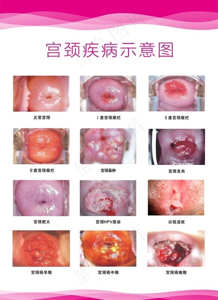 宫颈示意图图片cdr矢量模版下载