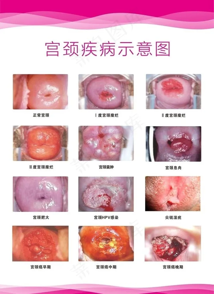 宫颈示意图图片cdr矢量模版下载