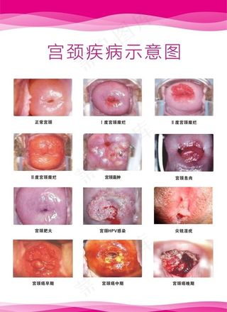 宫颈示意图图片