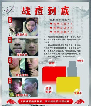 战痘到底图片