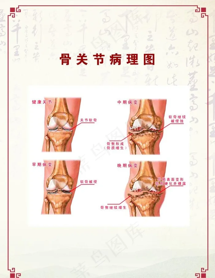 骨关节病理图图片(900X1200)cdr矢量模版下载