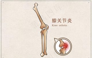 膝关节炎骨骼宣传展板素材图片