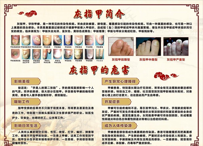 灰指甲的危害 灰指甲简介图片cdr矢量模版下载
