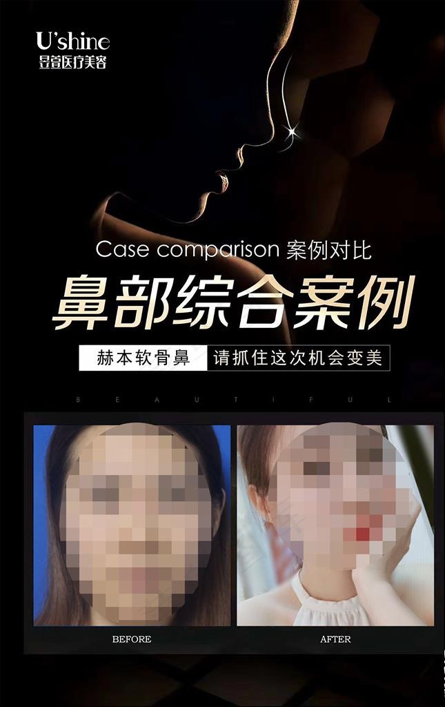 医美整形医院案例对比海报图片(3543X5361(DPI:150))psd模版下载