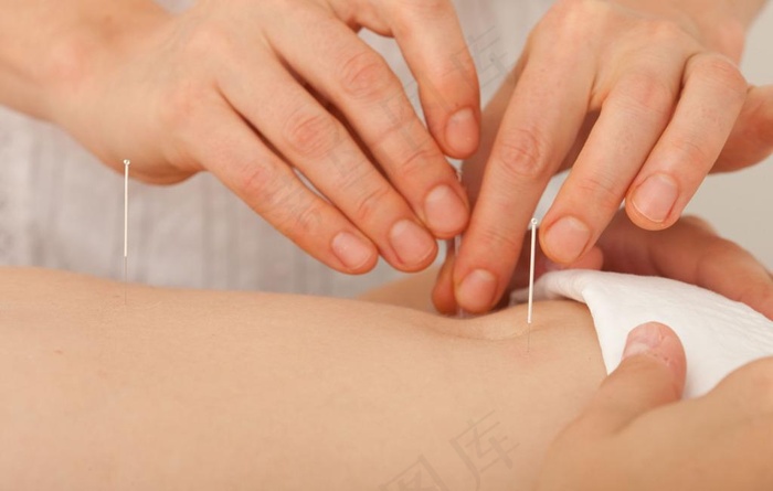 中医针灸图片