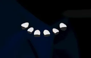 贴面 美学修复图片