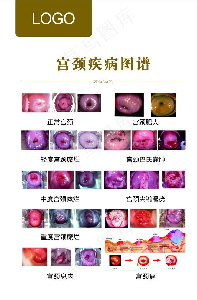 宫颈疾病图谱图片cdr矢量模版下载