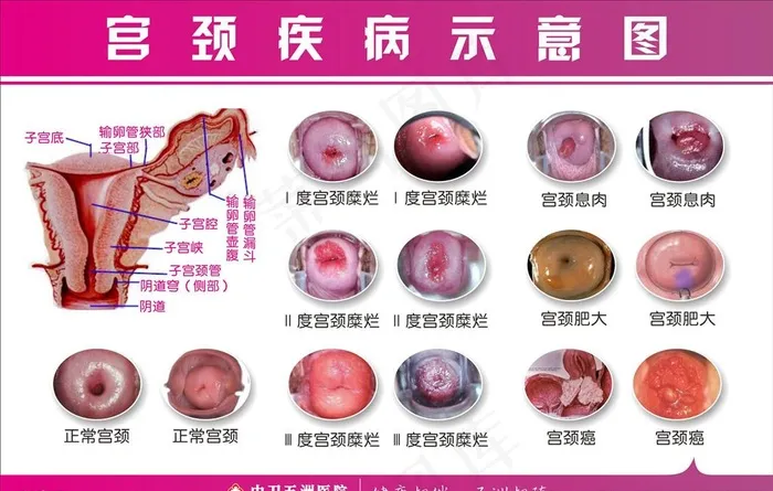 宫颈疾病图片cdr矢量模版下载