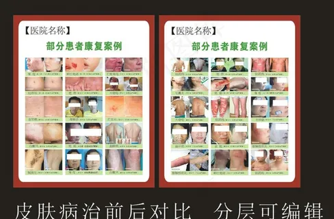 皮肤病治疗对比图图片