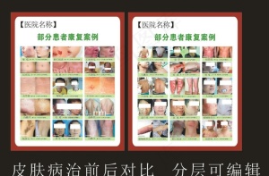 皮肤病治疗对比图图片