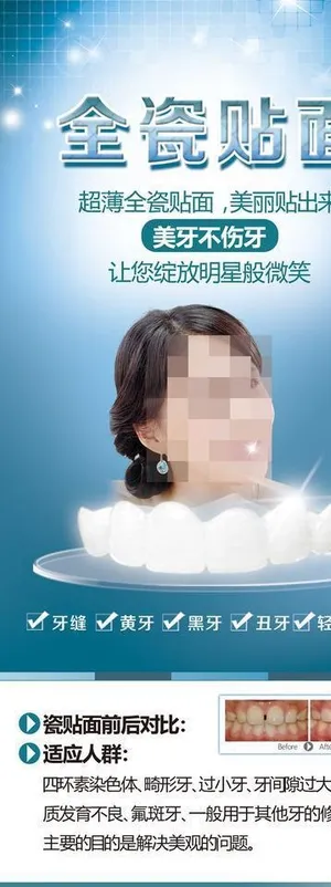 瓷贴面图片