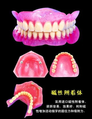 磁性附着体牙科图片