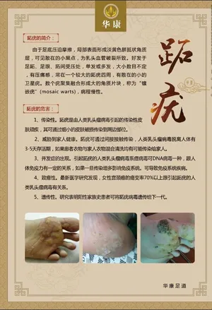 足疗 跖疣zhiyou图片