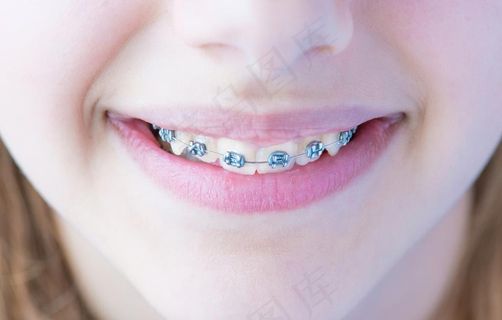 牙齿矫正图片