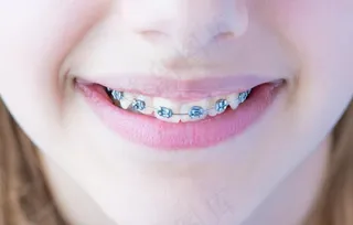 牙齿矫正图片