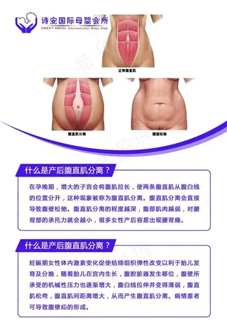 产后腹直肌分离图片
