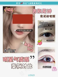 双眼皮案例对比图图片