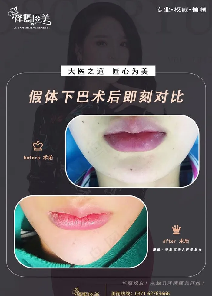 医美整形下巴图片psd模版下载