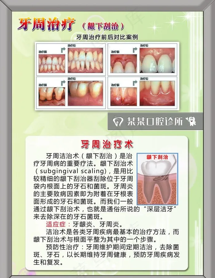 口腔科 牙周治疗图片(4724X6299(DPI:200))psd模版下载