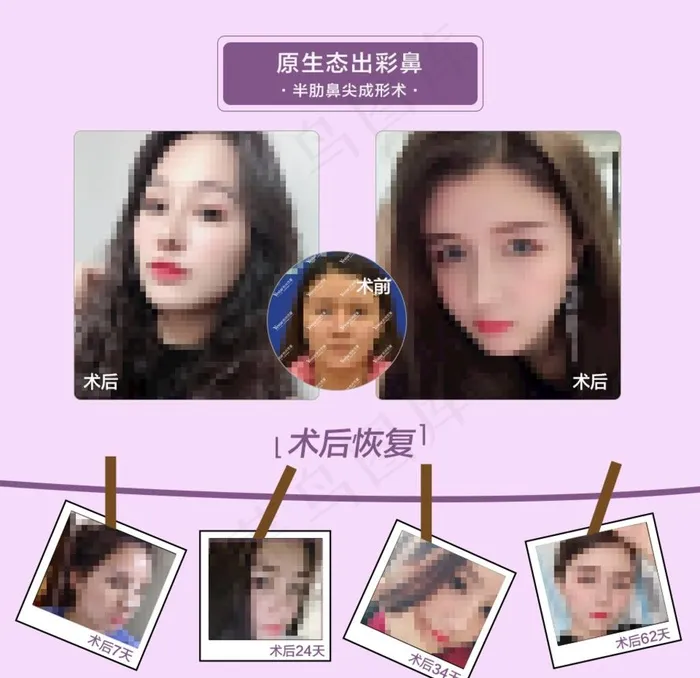 整形案例对比图图片(960X960(DPI:72))psd模版下载