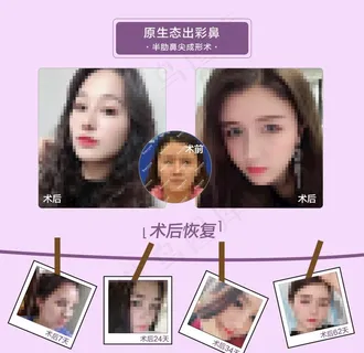 整形案例对比图图片