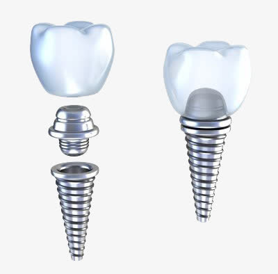种植牙补牙免抠