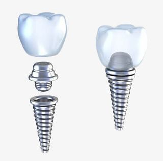 种植牙补牙免抠