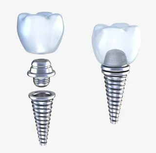 种植牙补牙免抠